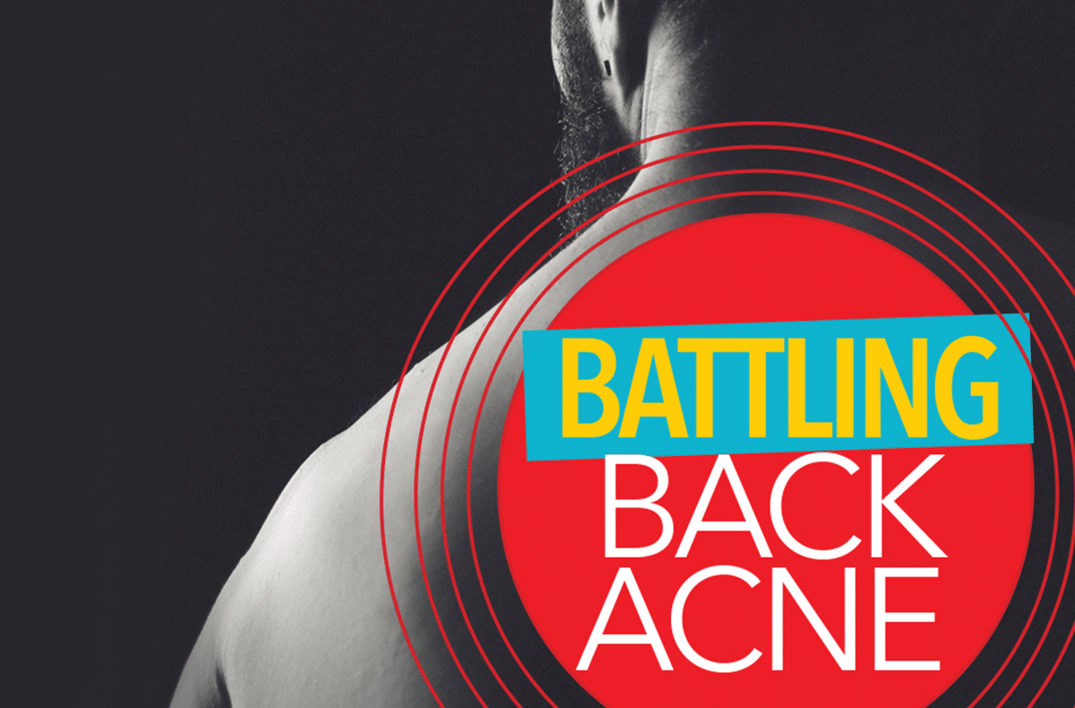 Back acne: How to get rid of it