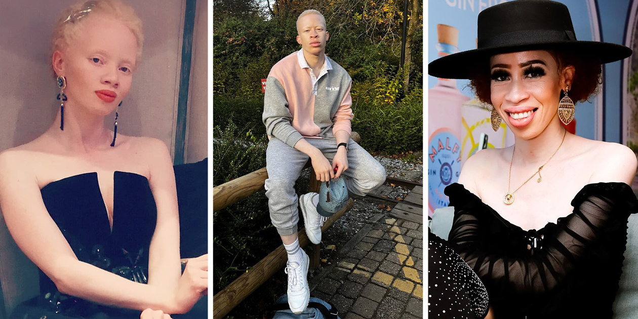 Local albino celebs serving as inspiration