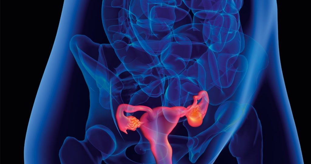 PCOS 101